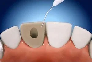 Kanal Tedavisi Sonrası Renklenmiş Dişlerin Beyazlatılması(Devital Beyazlatma)