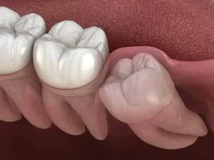 Kırık Diş Restorasyonları
